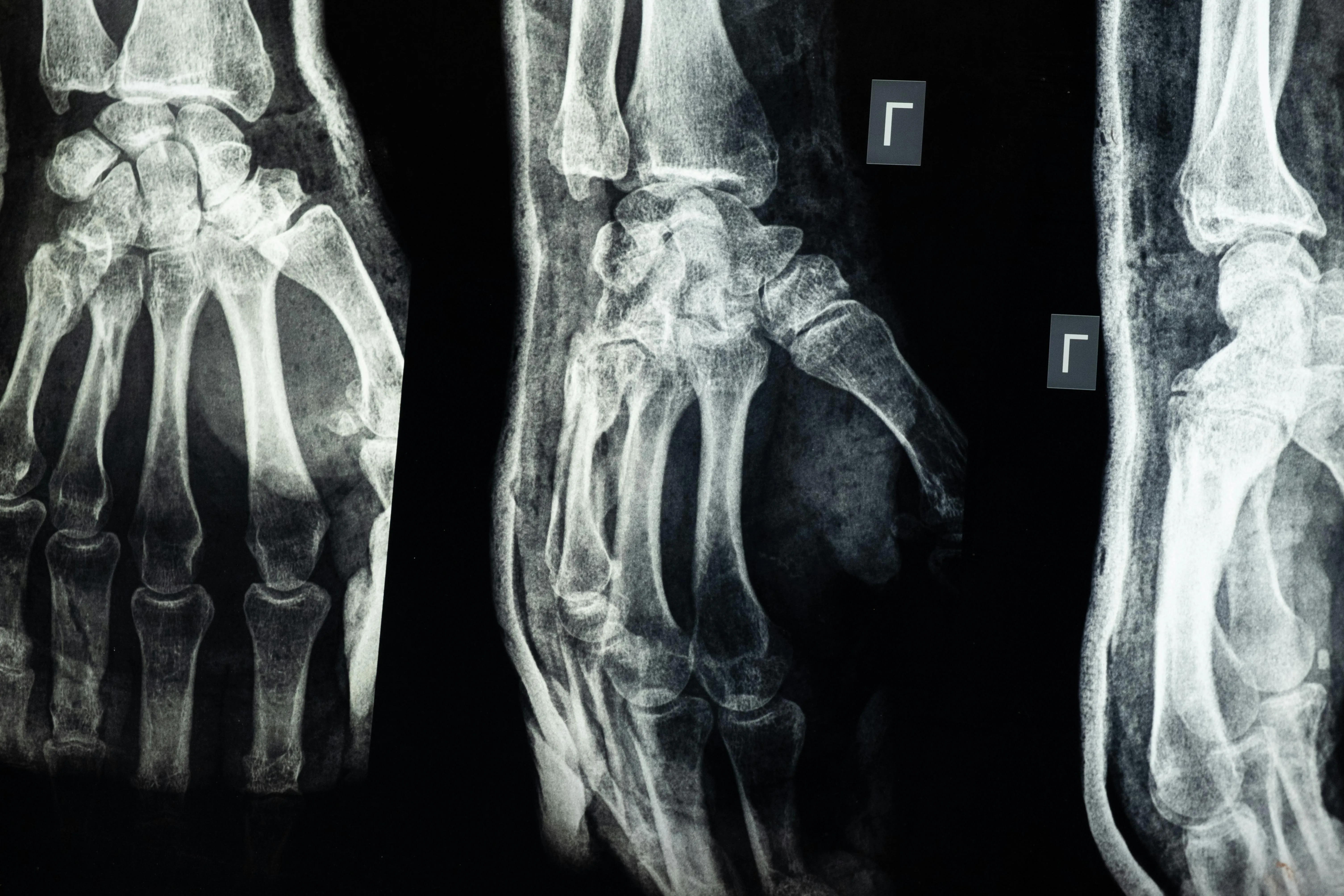 Detailed X-ray film showing bone structure